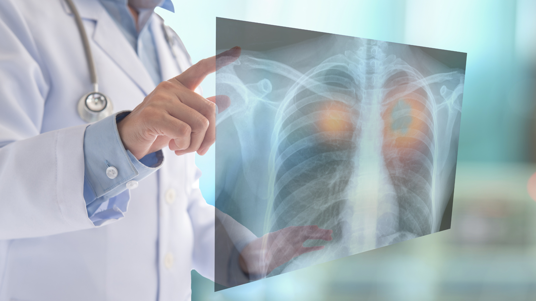 Radon Cause Lung Cancer